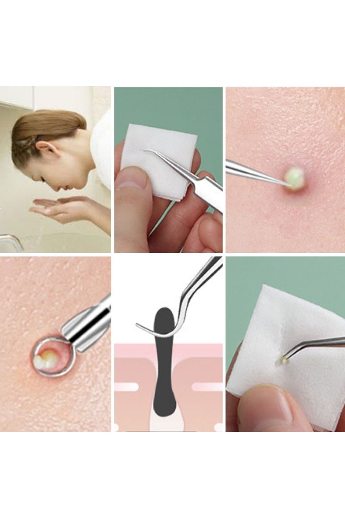 Tbl Dekor®11 Parça Siyah Nokta Temizleyici Cilt Bakım Komedon Seti